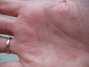 алергічний дерматит на руках