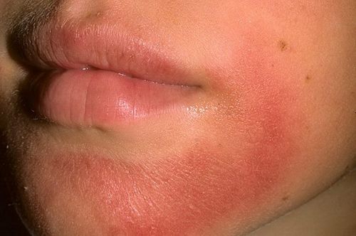 алергічний алергія свербіж шкіра зняти