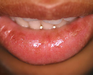 як лікувати алергію у роті