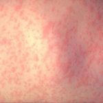 алергію лікують глистами