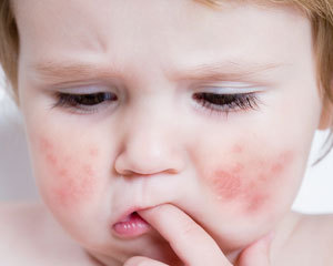як лікувати алергію у новонародженого