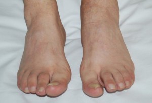 лікування захворювання артриту суглобів пальців ніг