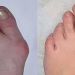 лікувати суглоби пальців ніг