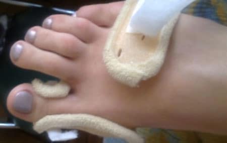 артроз великого пальця ноги симптоми лікування народними засобами
