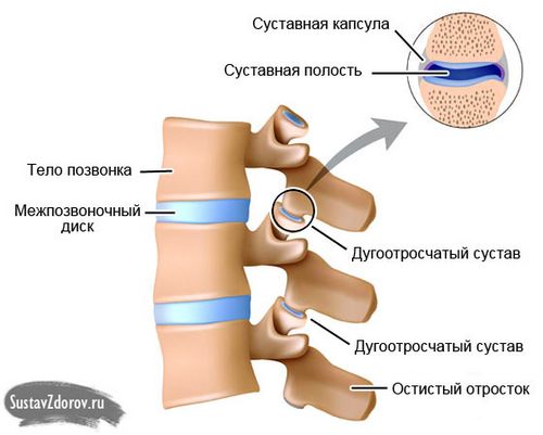 як лікувати фасеточний артроз