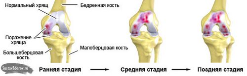 як лікувати артроз 2 ступеня колінного суглоба