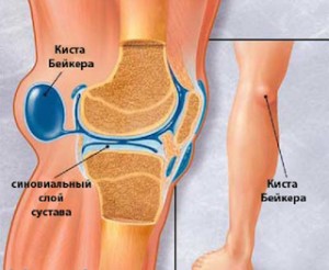 артроз колінного суглоба