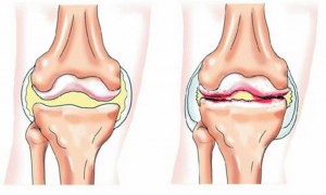 артроз колінного сустрава: симптоми і лікування