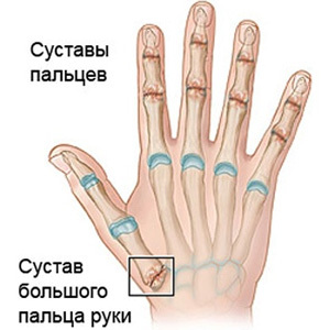 як лікувати артроз пальців рук