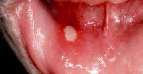 біла болячка в роті лікування