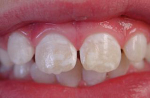 білі плями на зубах