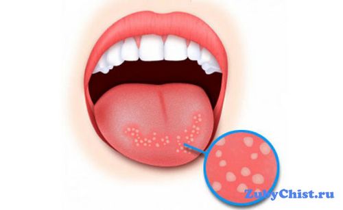 як лікувати стоматит під язиком