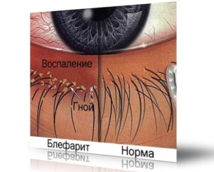 як лікувати блефарит очей