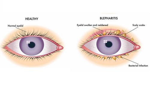 як лікувати блефарит очей