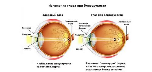 короткозорість у дітей шкільного віку лікування вітаміни для очей профілактика підлітки як лікувати помилкова гімнастика вроджена причини міопія