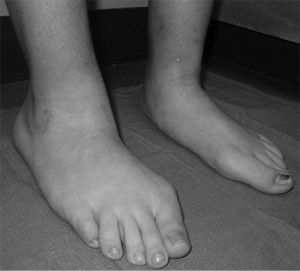 як вилікувати хворі нігті на ногах