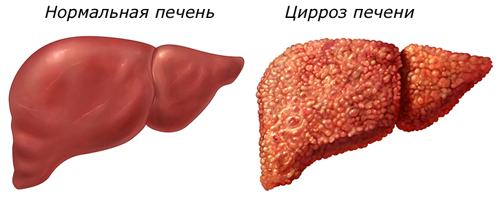 лікувати печінку після алкоголю