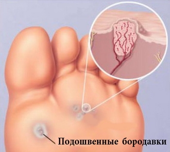 вилікувати бородавки на стопі