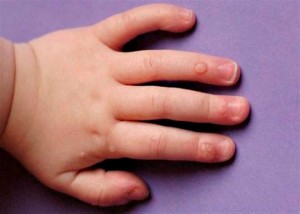 бородавки дітей лікування лікувати пальці дитини стопі лазер