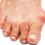 як лікувати бурсит великого пальця ноги