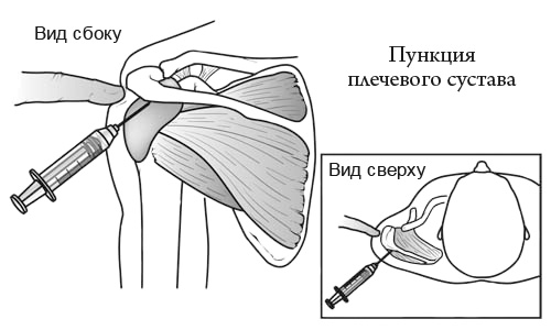 ніж лікувати бурсит плечового суглоба