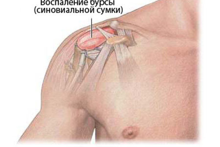 бурсит плечового суглоба симптоми лікування субакроміальний подклювовідний