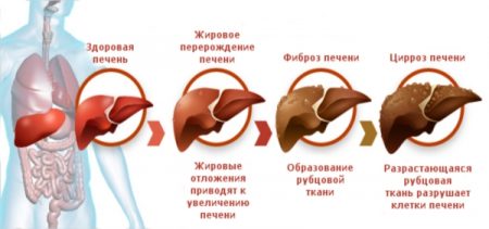 лікувати печінку після алкоголю