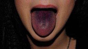 як лікувати чорний язик