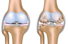 як лікувати деформуючий артроз колінного суглоба