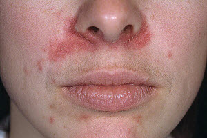 як вилікувати алергічний дерматит на обличчі