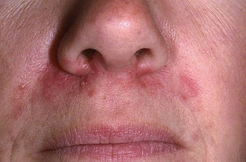 дерматит на обличчі атопічний алергічний себорейний лікування народний засіб стероїдний розацеаподобний симптом