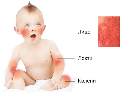 як лікувати дерматит на обличчі у дитини