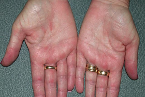 як лікувати дерматит на руках в домашніх умовах