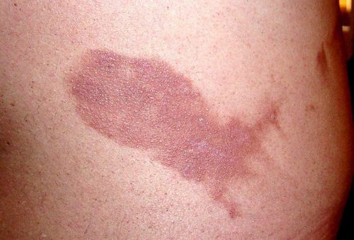 дерматит тілі спині ліктях підборідді пахвами фото