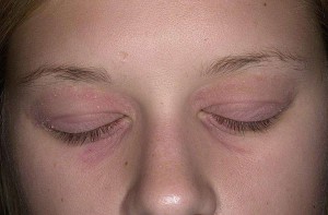 як лікувати дерматит навколо очей