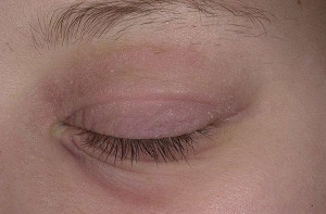 як лікувати дерматит навколо очей