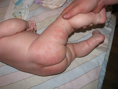 як лікувати атопічний дерматит у немовляти