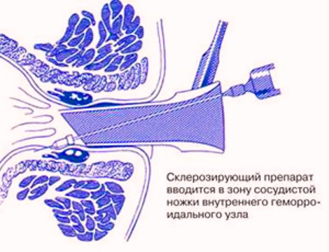 як лікувати геморой 4 стадії