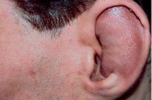 екзема вухо зовнішній слуховий прохід фото лікування раковина