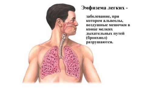 як лікують емфізему легенів