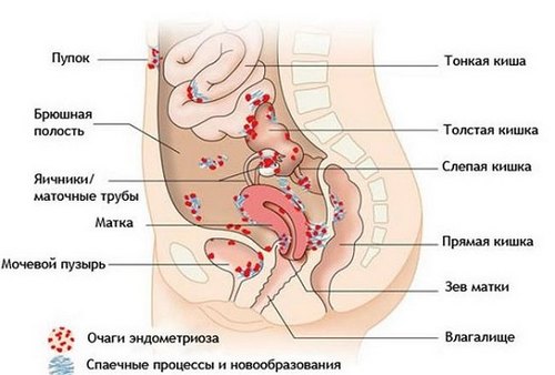 ендометріоз кишечник причини симптоми діагностика лікування захворювання статева система