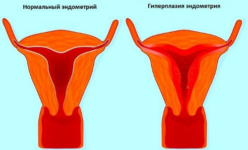 як лікувати хворобу ендометріоз