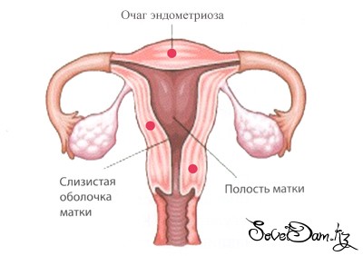 як лікувати ендометріоз після аборту