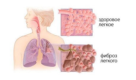 як лікувати фіброз легенів