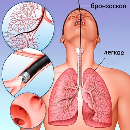 фіброз легені причини форми діагностика лікування профілактика симптоми захворювання сполучна тканина