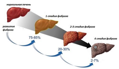 як лікувати фіброз печінки 4 ступеня