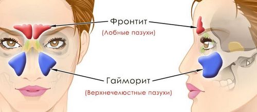 як лікувати синусит гайморит