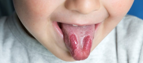 як вилікувати географічний язик у дитини