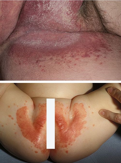 грибковий кандидозний дерматит фото пелюшковий лікування у дітей дорослих як виглядає
