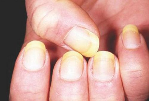 лікувати грибок нігтів на руках